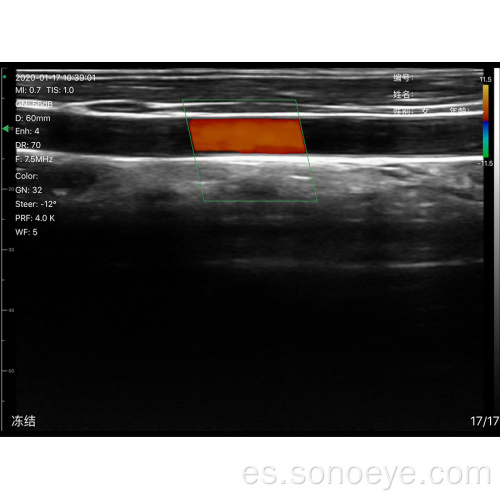 Súper ancho escáner de ultrasonido lineal para inspección de senos
